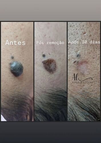 Antes e depois